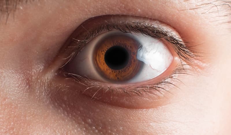 Upper Eyelid Surgery
