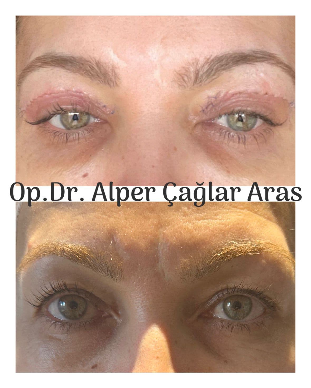 Case 01 · upper blepharoplasty