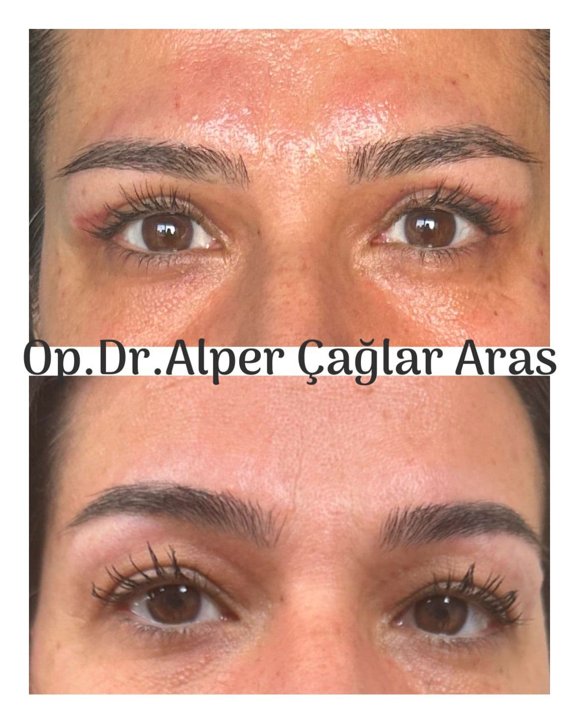 Case 02 · upper blepharoplasty