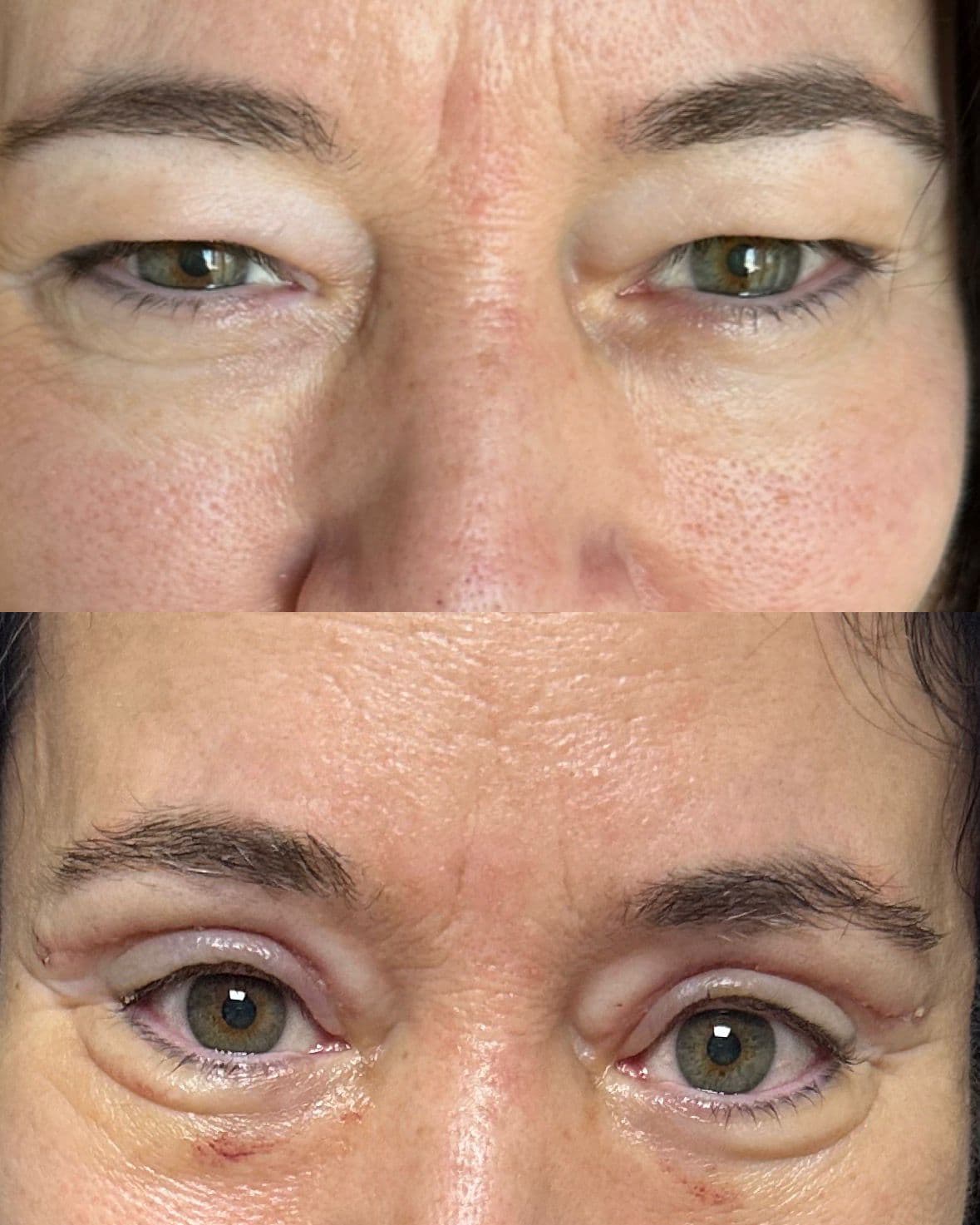Case 03 · upper blepharoplasty